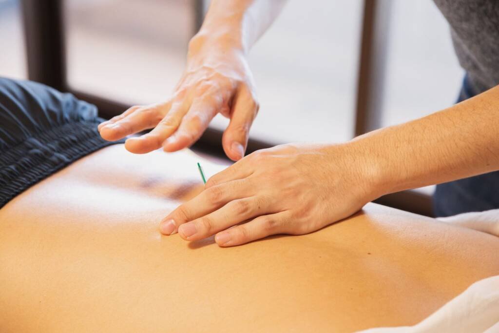 Practitioner placing fine acupuncture needles along a patient’s lower back during a treatment session